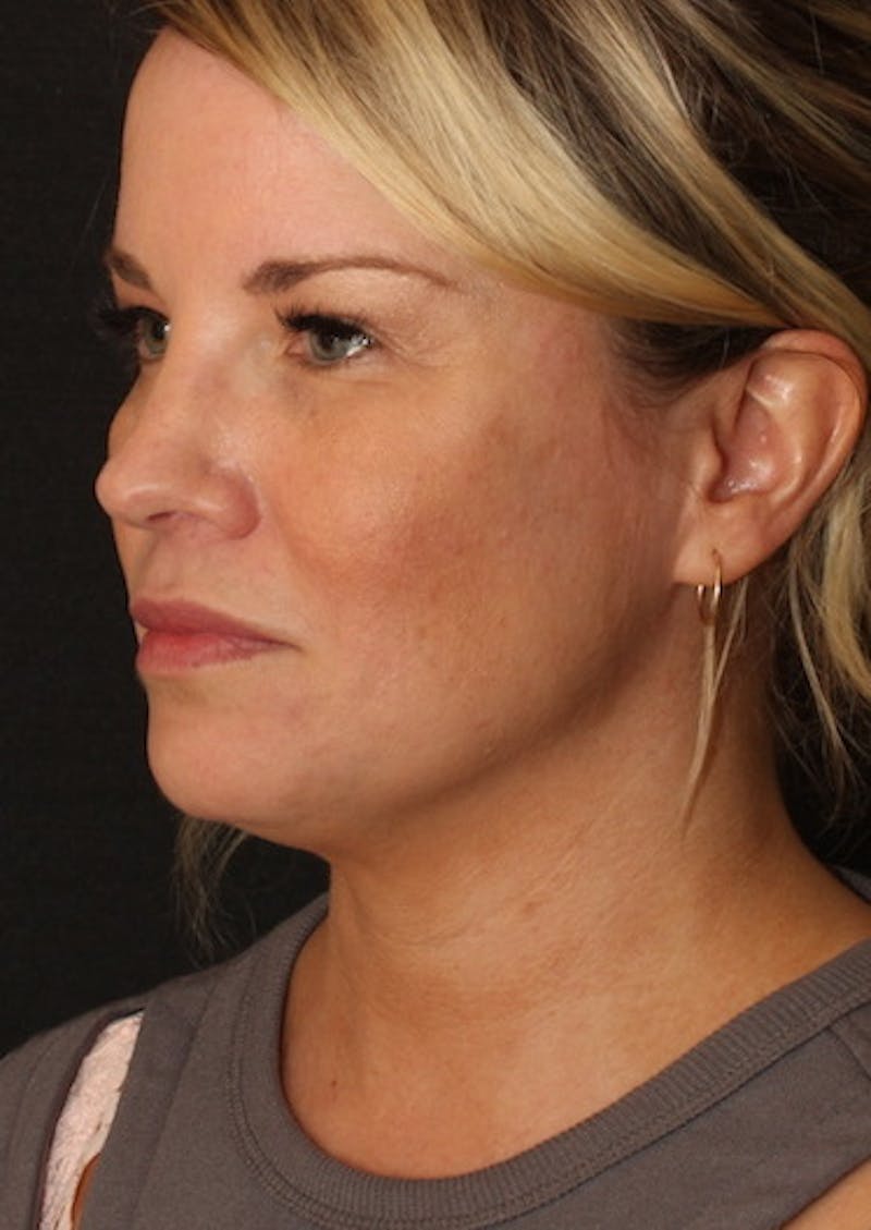 Facetite Before & After Gallery - Patient 106387149 - Image 8