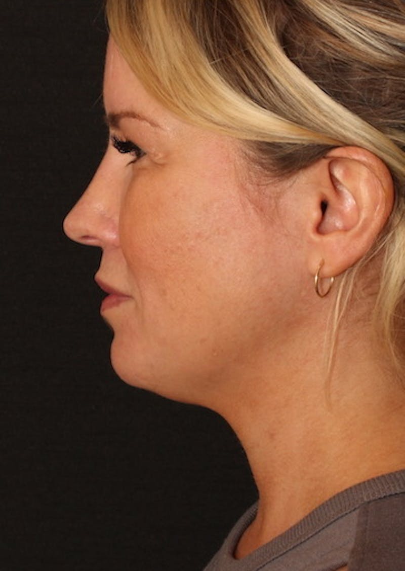 Facetite Before & After Gallery - Patient 106387149 - Image 10