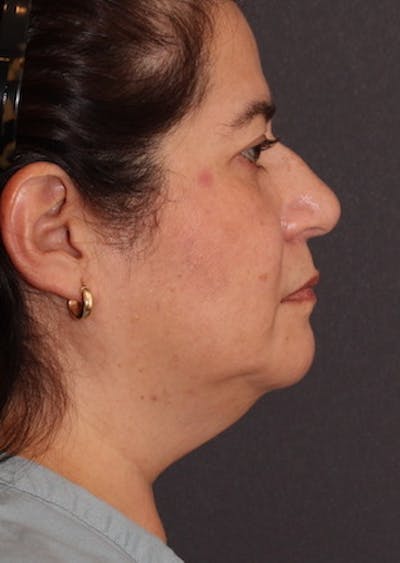 Facetite Before & After Gallery - Patient 106387302 - Image 1