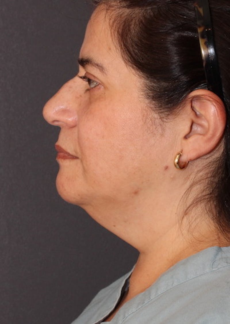 Facetite Before & After Gallery - Patient 106387302 - Image 9