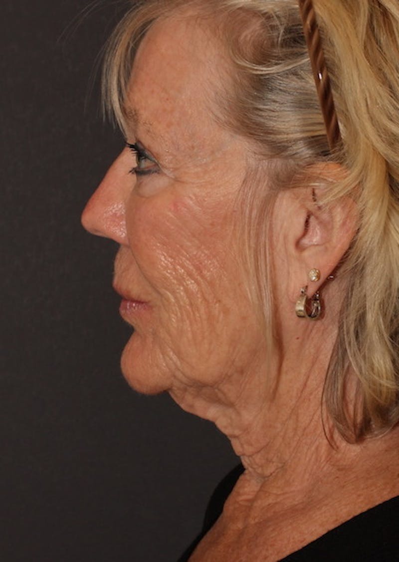 Facetite Before & After Gallery - Patient 106387347 - Image 9