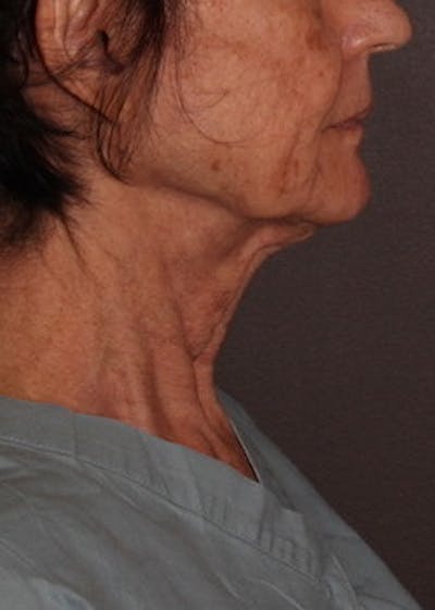 Facetite Before & After Gallery - Patient 106388577 - Image 1