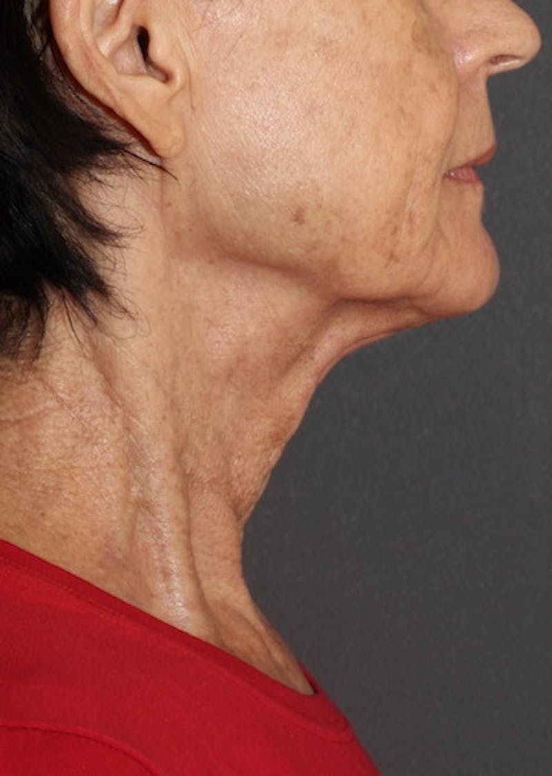 Facetite Before & After Gallery - Patient 106388577 - Image 2