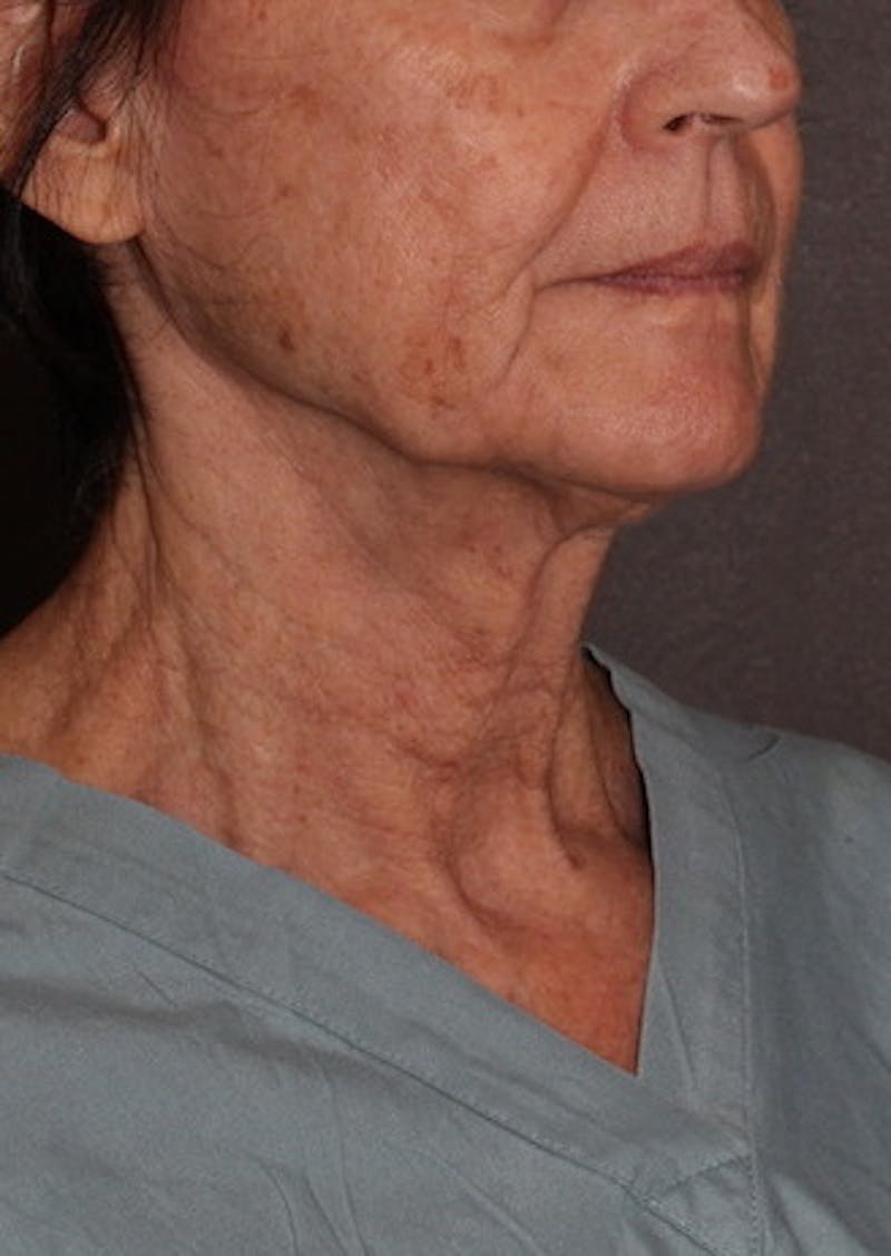 Facetite Before & After Gallery - Patient 106388577 - Image 3