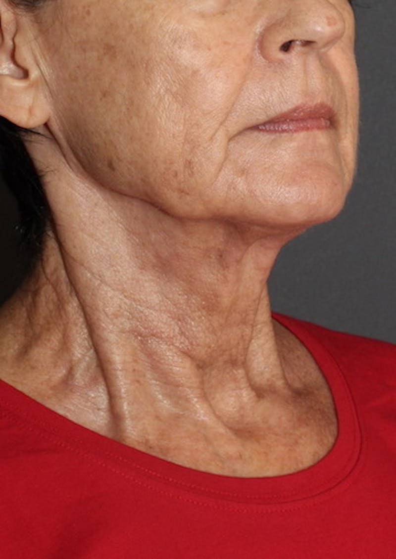 Facetite Before & After Gallery - Patient 106388577 - Image 4