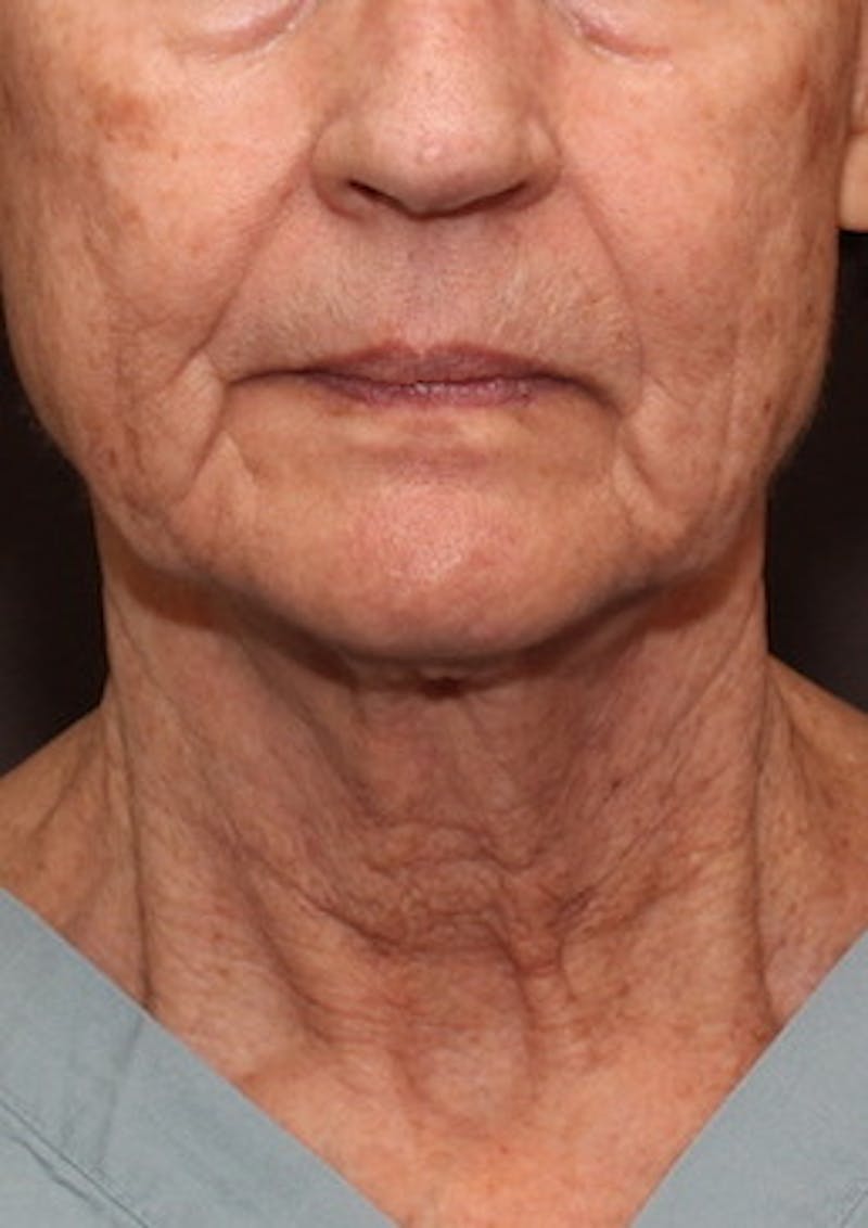 Facetite Before & After Gallery - Patient 106388577 - Image 5