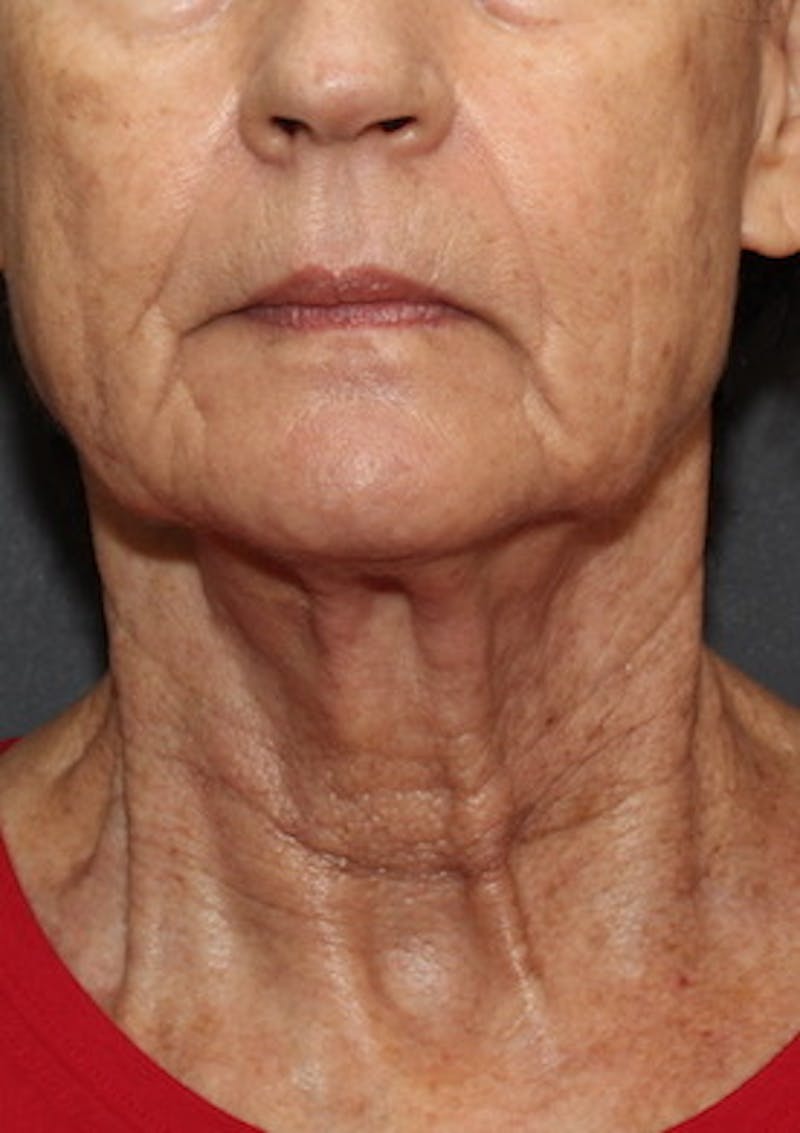 Facetite Before & After Gallery - Patient 106388577 - Image 6