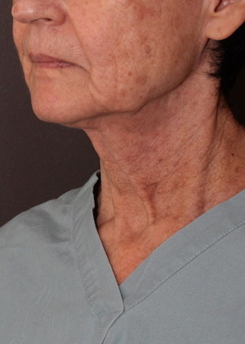 Facetite Before & After Gallery - Patient 106388577 - Image 7