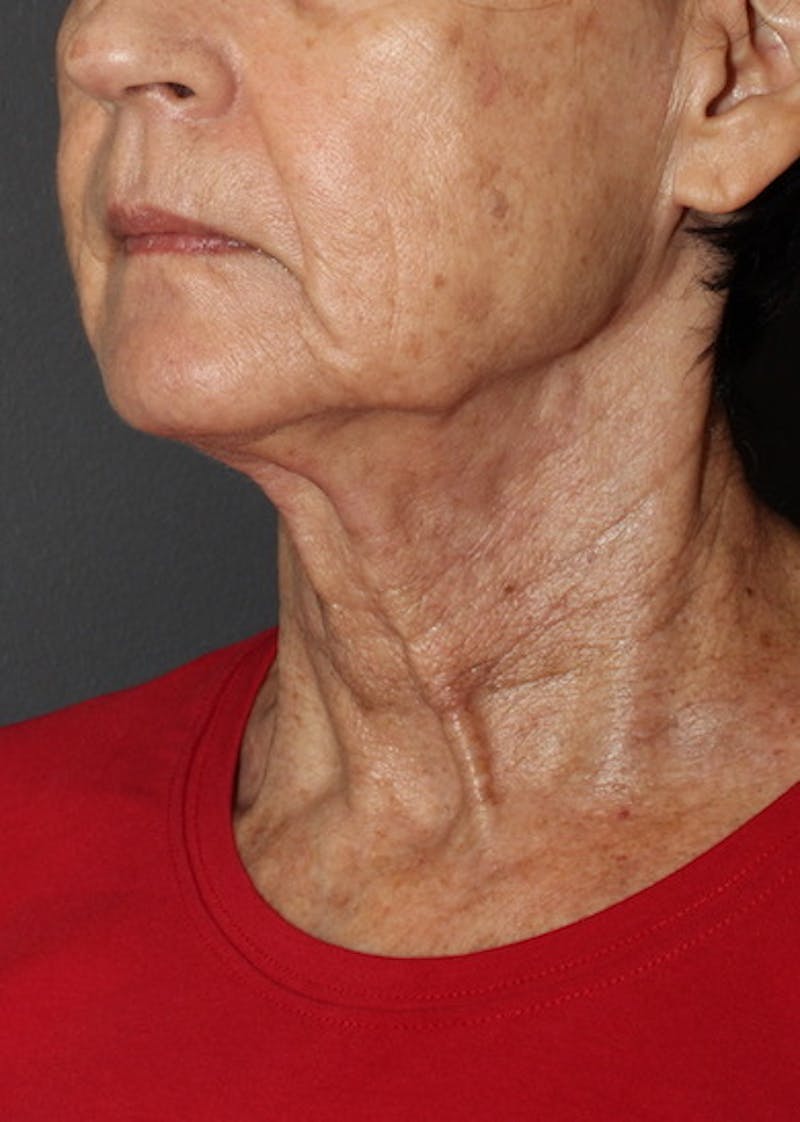 Facetite Before & After Gallery - Patient 106388577 - Image 8