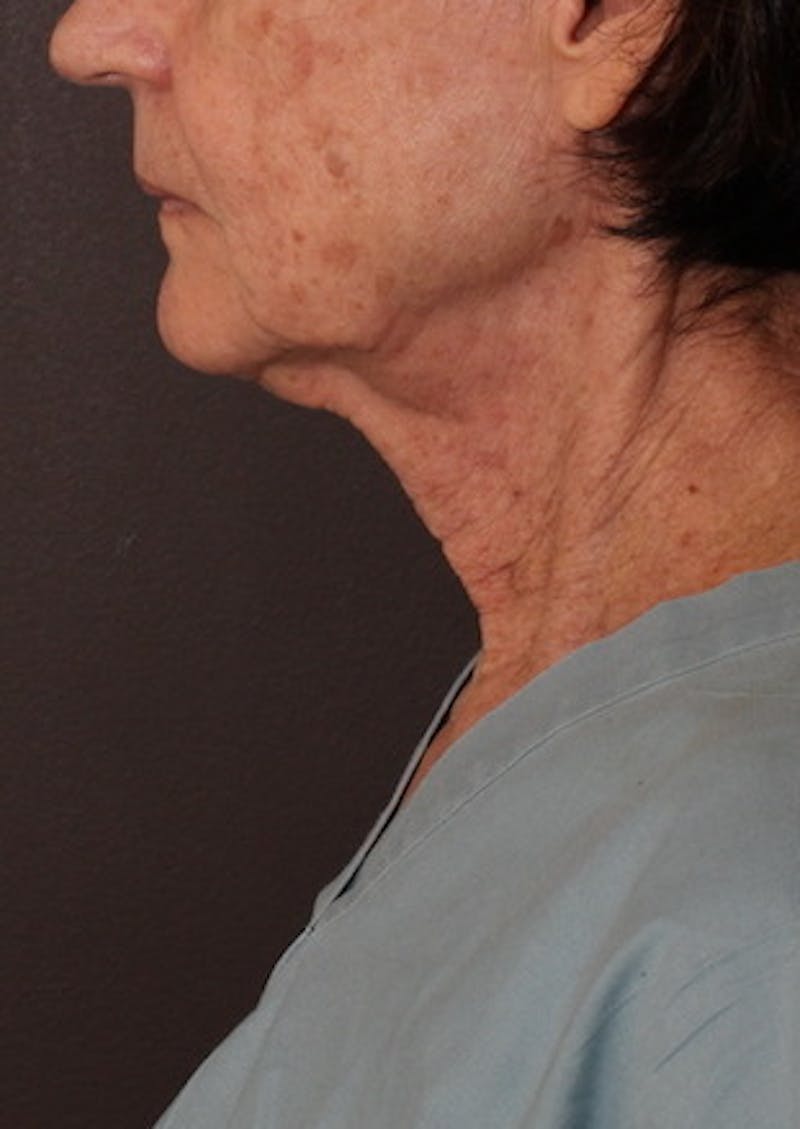 Facetite Before & After Gallery - Patient 106388577 - Image 9