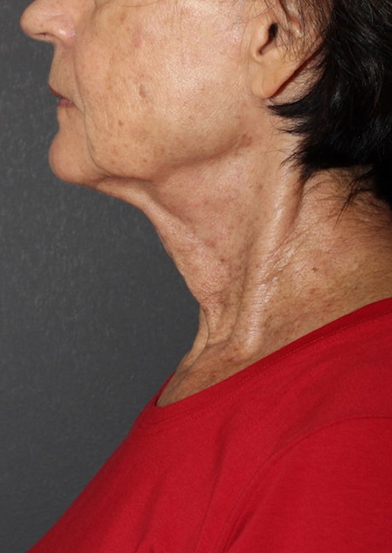 Facetite Before & After Gallery - Patient 106388577 - Image 10