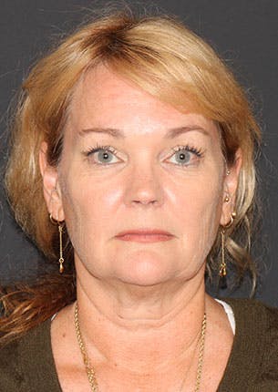 Facelift