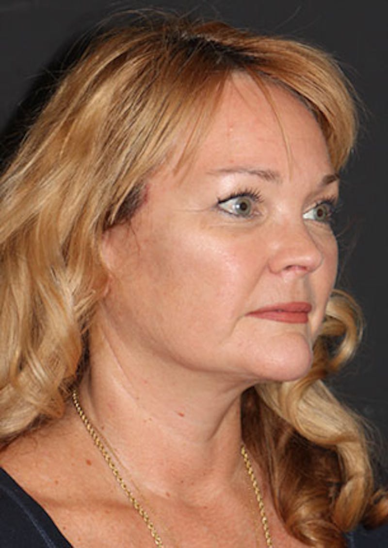 Facelift/Necklift Before & After Gallery - Patient 106389228 - Image 6