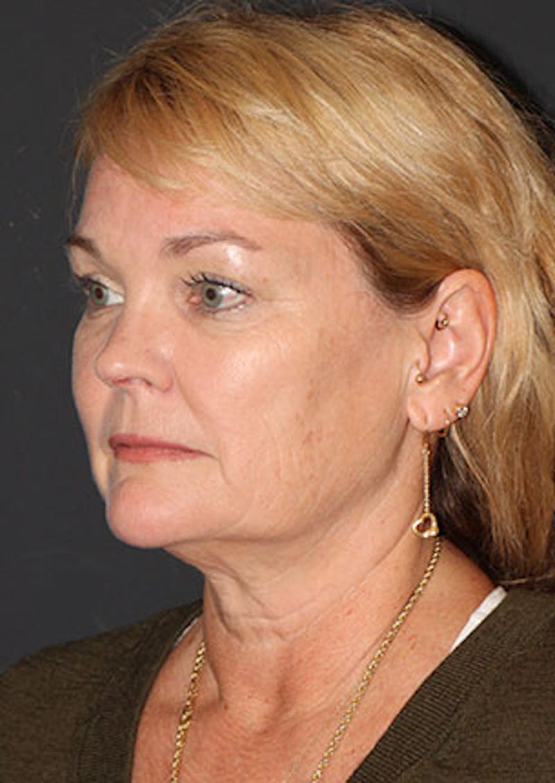 Facelift/Necklift Before & After Gallery - Patient 106389228 - Image 7