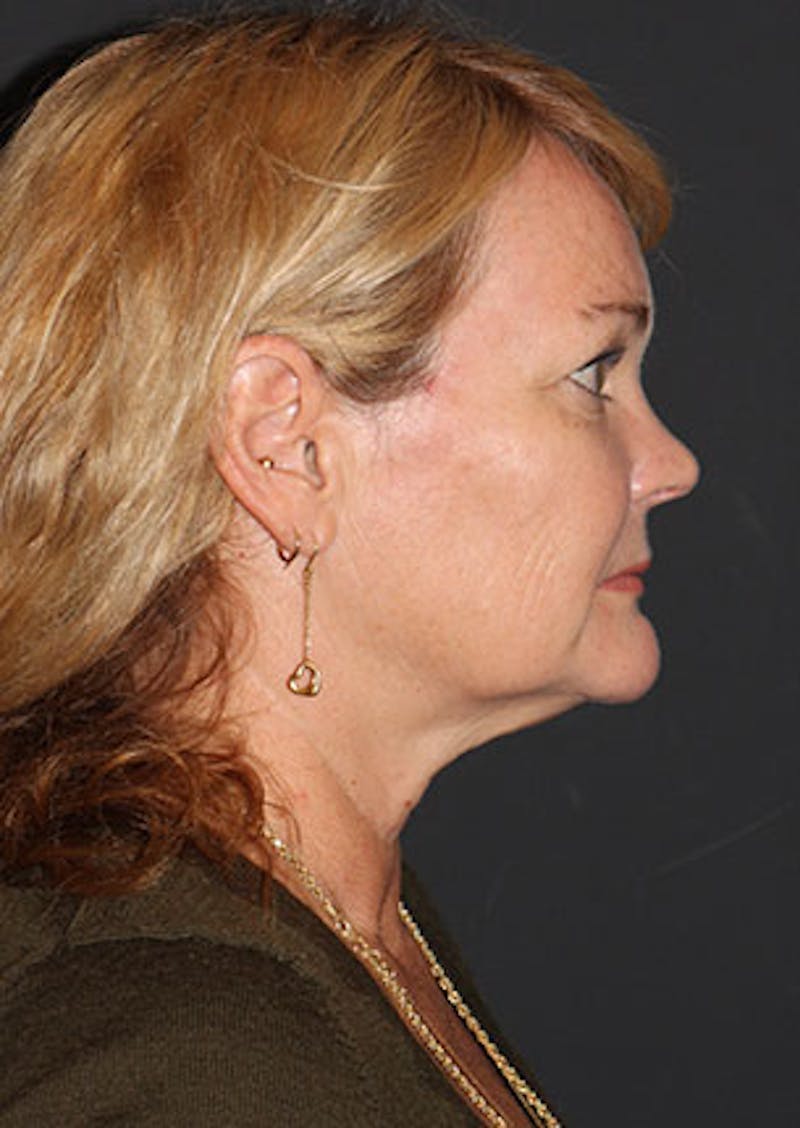Facelift/Necklift Before & After Gallery - Patient 106389228 - Image 9