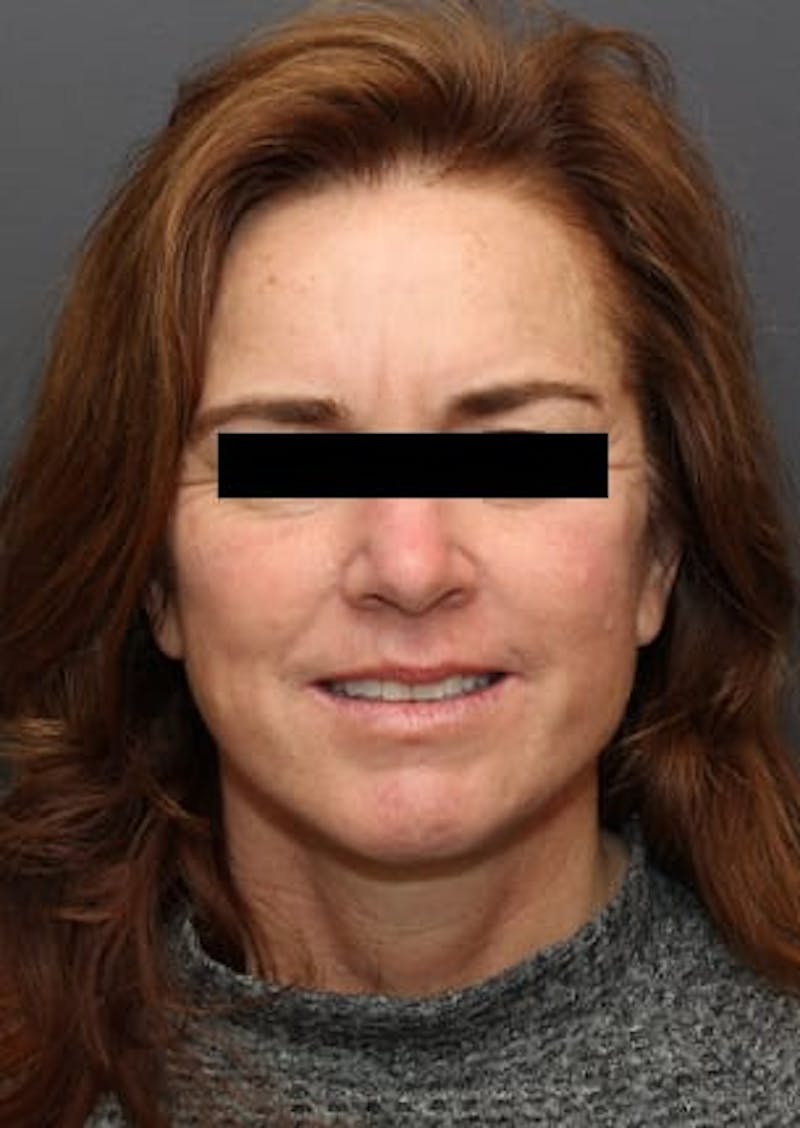 Facelift/Necklift Before & After Gallery - Patient 106389238 - Image 2
