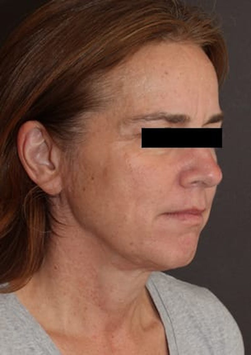 Facelift/Necklift Before & After Gallery - Patient 106389238 - Image 3