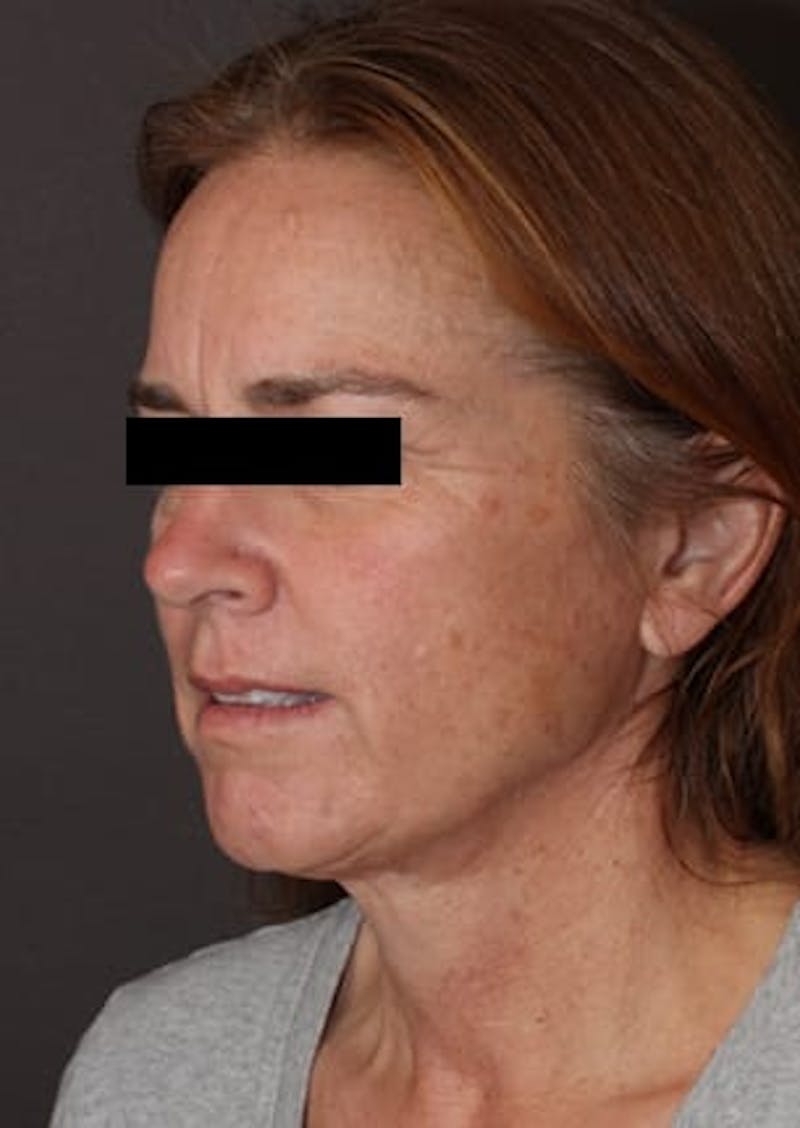 Facelift/Necklift Before & After Gallery - Patient 106389238 - Image 5