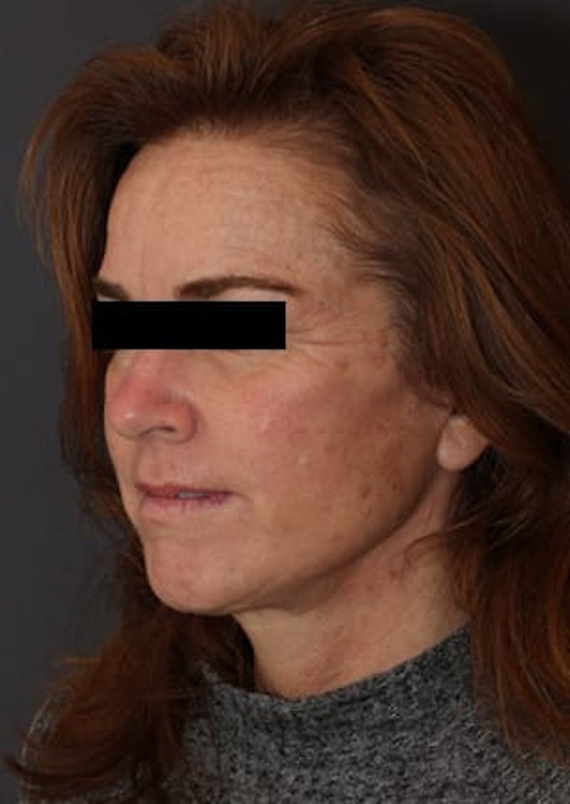 Facelift/Necklift Before & After Gallery - Patient 106389238 - Image 6