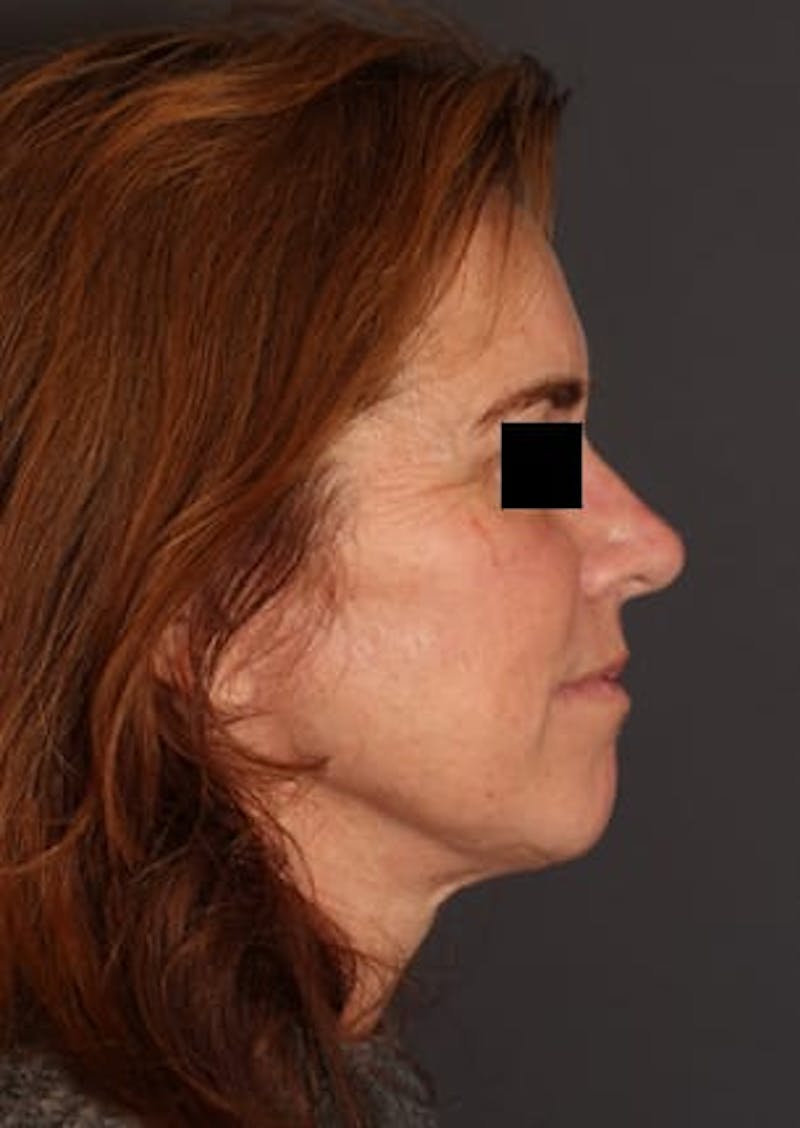 Facelift/Necklift Before & After Gallery - Patient 106389238 - Image 8