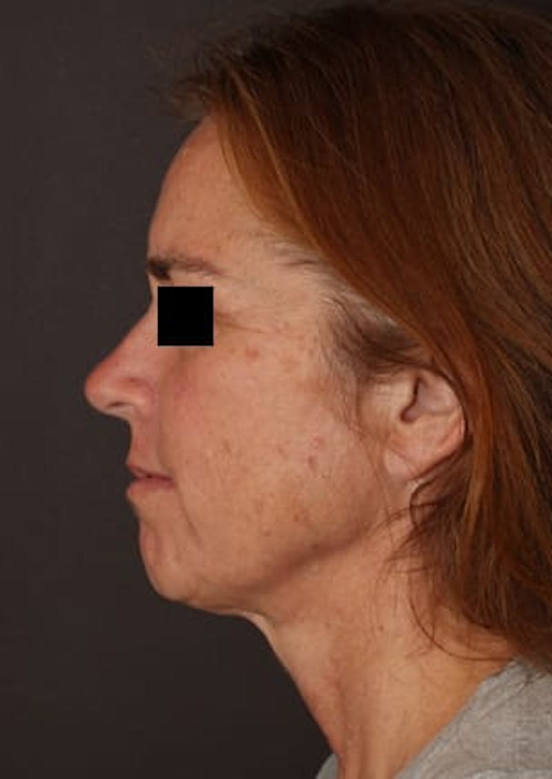 Facelift/Necklift Before & After Gallery - Patient 106389238 - Image 9