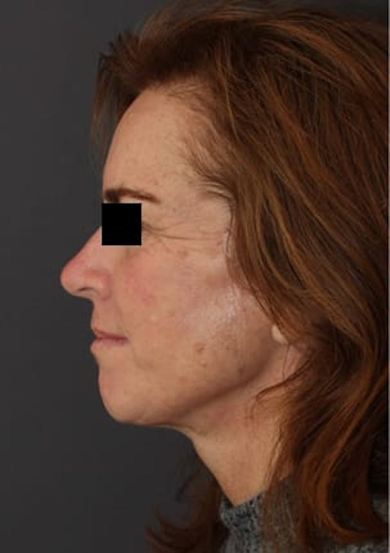 Facelift/Necklift Before & After Gallery - Patient 106389238 - Image 10
