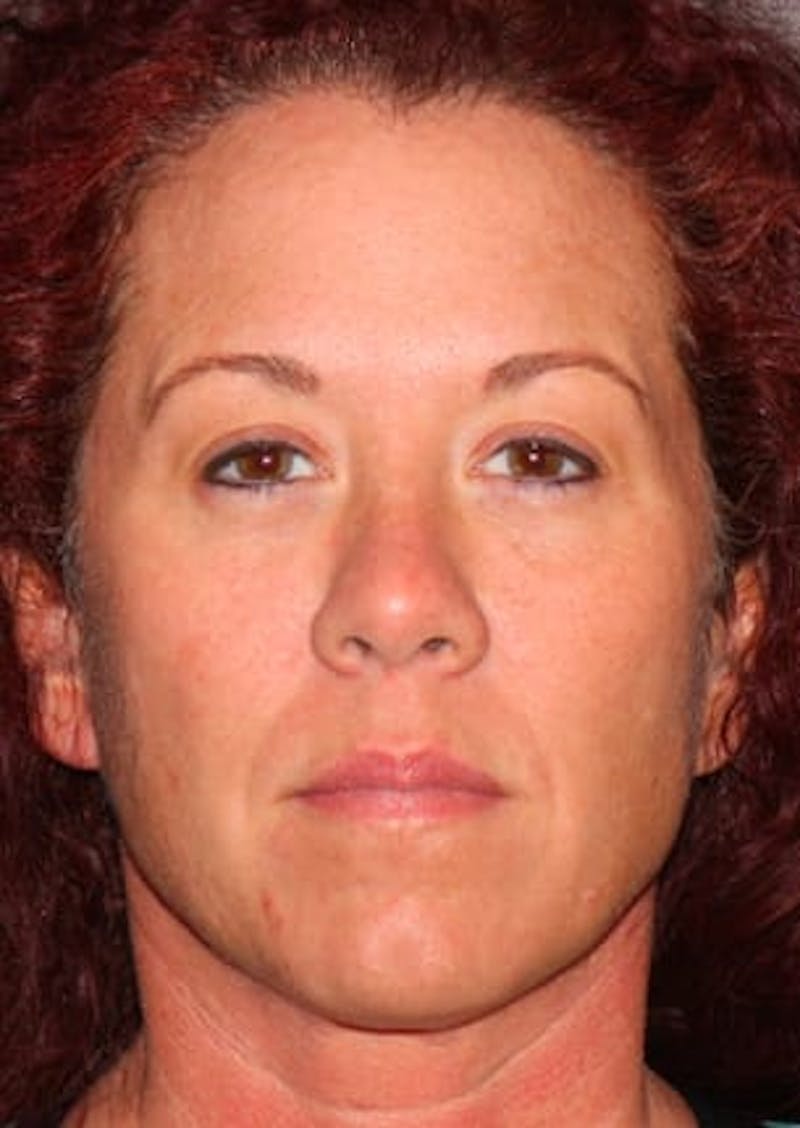 Facelift/Necklift Before & After Gallery - Patient 106389292 - Image 1