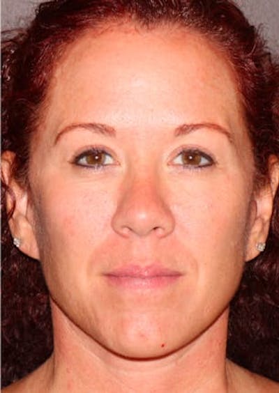 Facelift/Necklift Before & After Gallery - Patient 106389292 - Image 2