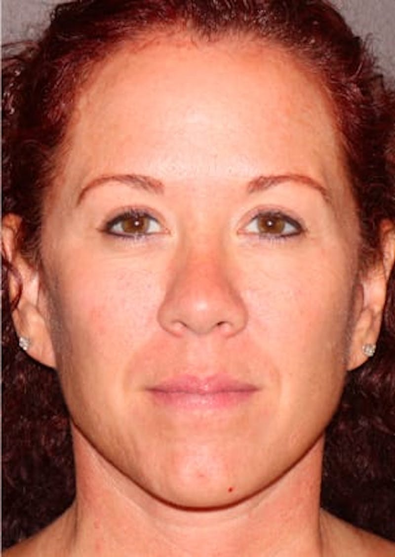 Facelift/Necklift Before & After Gallery - Patient 106389292 - Image 2