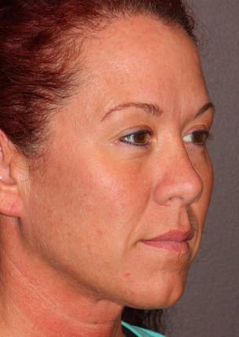 Facelift/Necklift Before & After Gallery - Patient 106389292 - Image 3