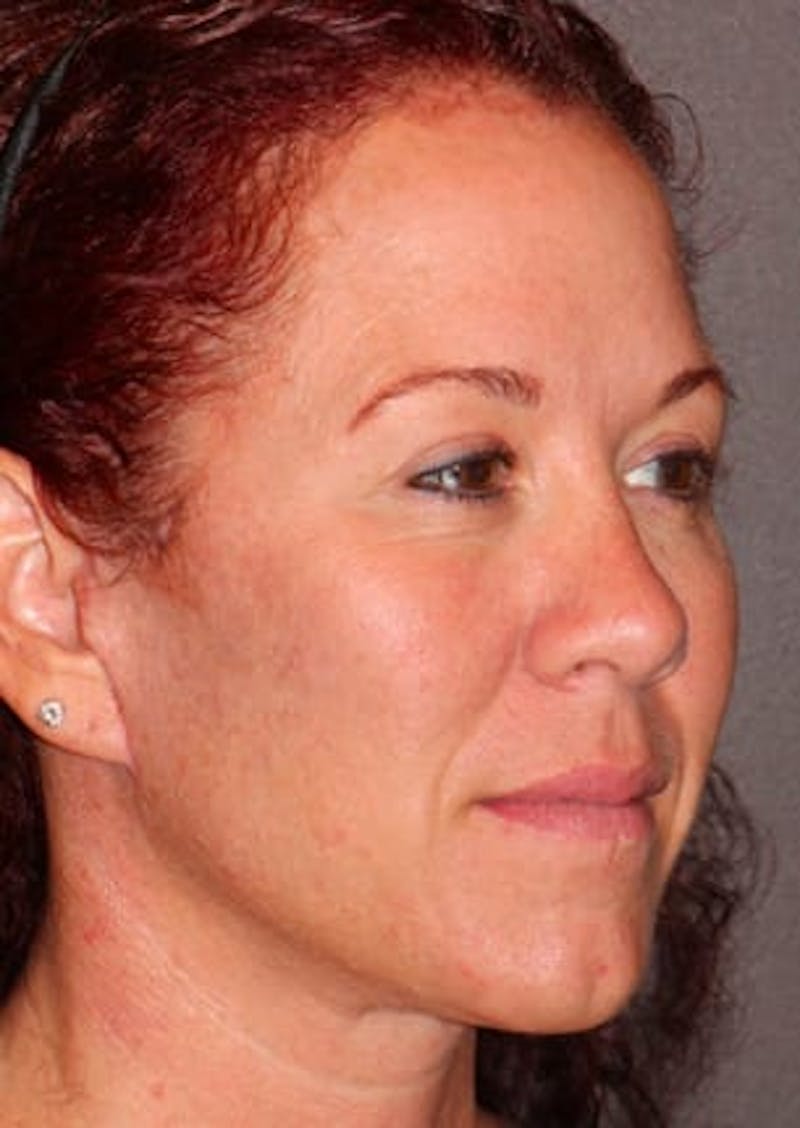 Facelift/Necklift Before & After Gallery - Patient 106389292 - Image 4
