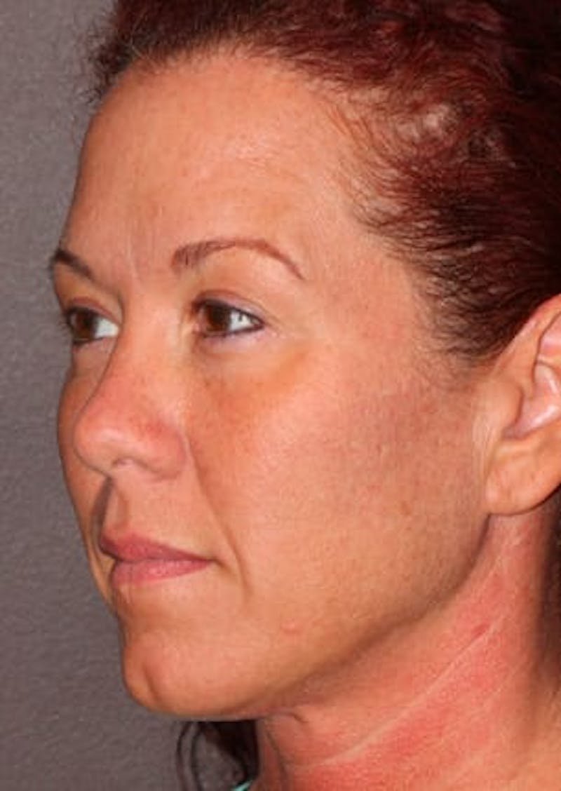 Facelift/Necklift Before & After Gallery - Patient 106389292 - Image 5