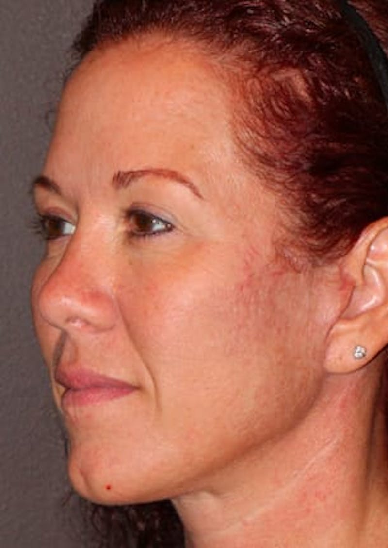 Facelift/Necklift Before & After Gallery - Patient 106389292 - Image 6