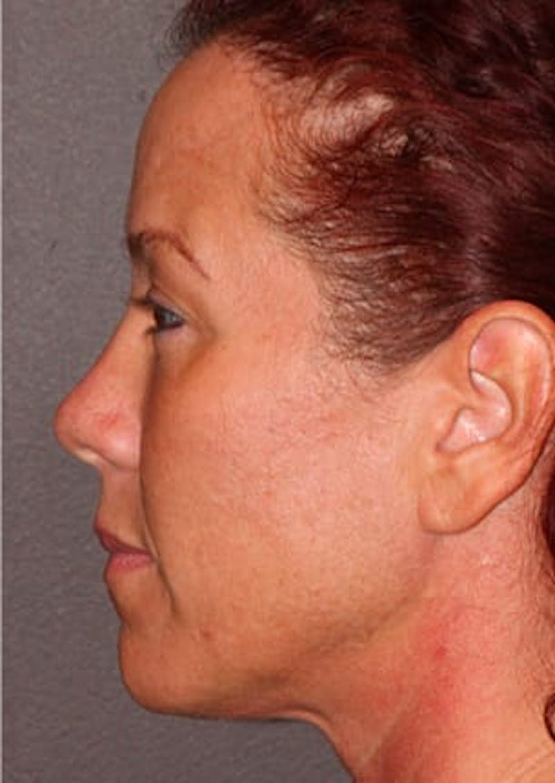 Facelift/Necklift Before & After Gallery - Patient 106389292 - Image 9