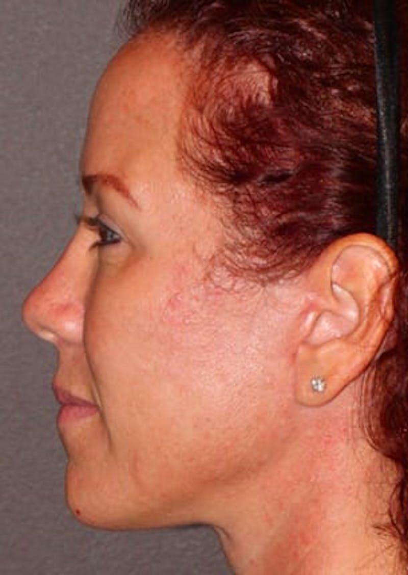 Facelift/Necklift Before & After Gallery - Patient 106389292 - Image 10
