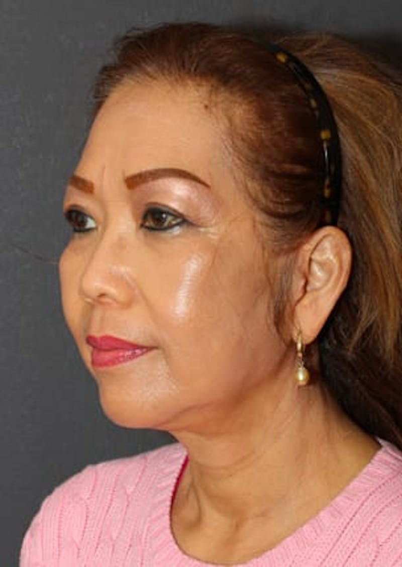 Facelift/Necklift Before & After Gallery - Patient 106397103 - Image 6