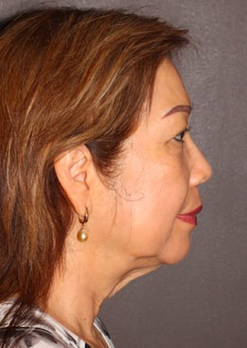Facelift/Necklift Before & After Gallery - Patient 106397103 - Image 7