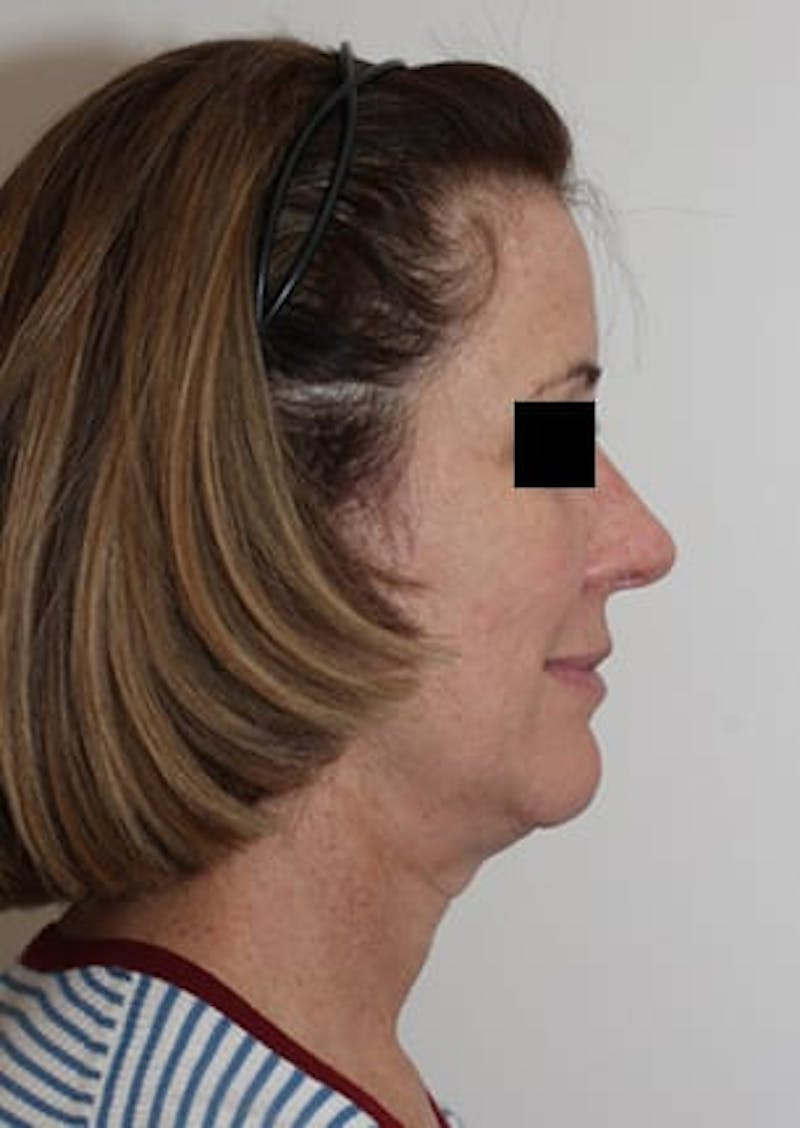 Facelift/Necklift Before & After Gallery - Patient 106523418 - Image 7
