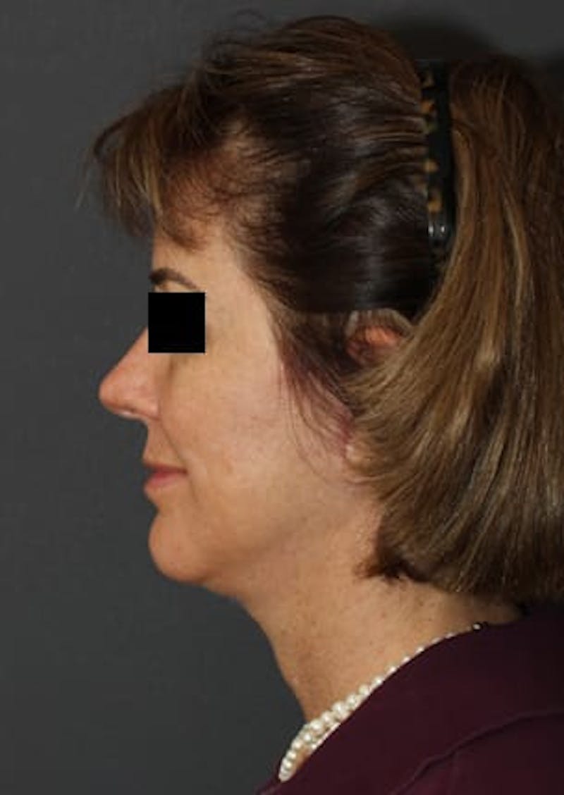 Facelift/Necklift Before & After Gallery - Patient 106523418 - Image 10