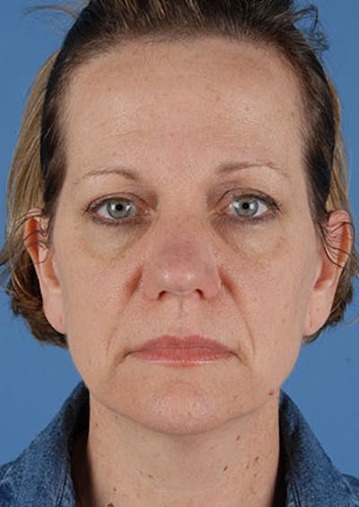 Facelift/Necklift Before & After Gallery - Patient 106537112 - Image 1
