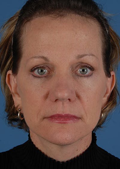Facelift/Necklift Before & After Gallery - Patient 106537112 - Image 2