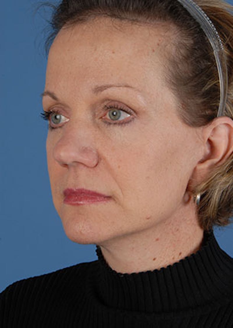 Facelift/Necklift Before & After Gallery - Patient 106537112 - Image 6