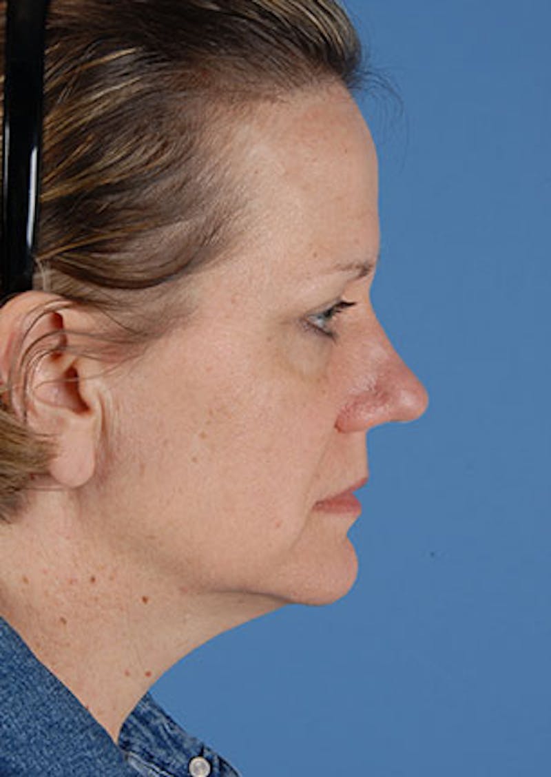 Facelift/Necklift Before & After Gallery - Patient 106537112 - Image 7