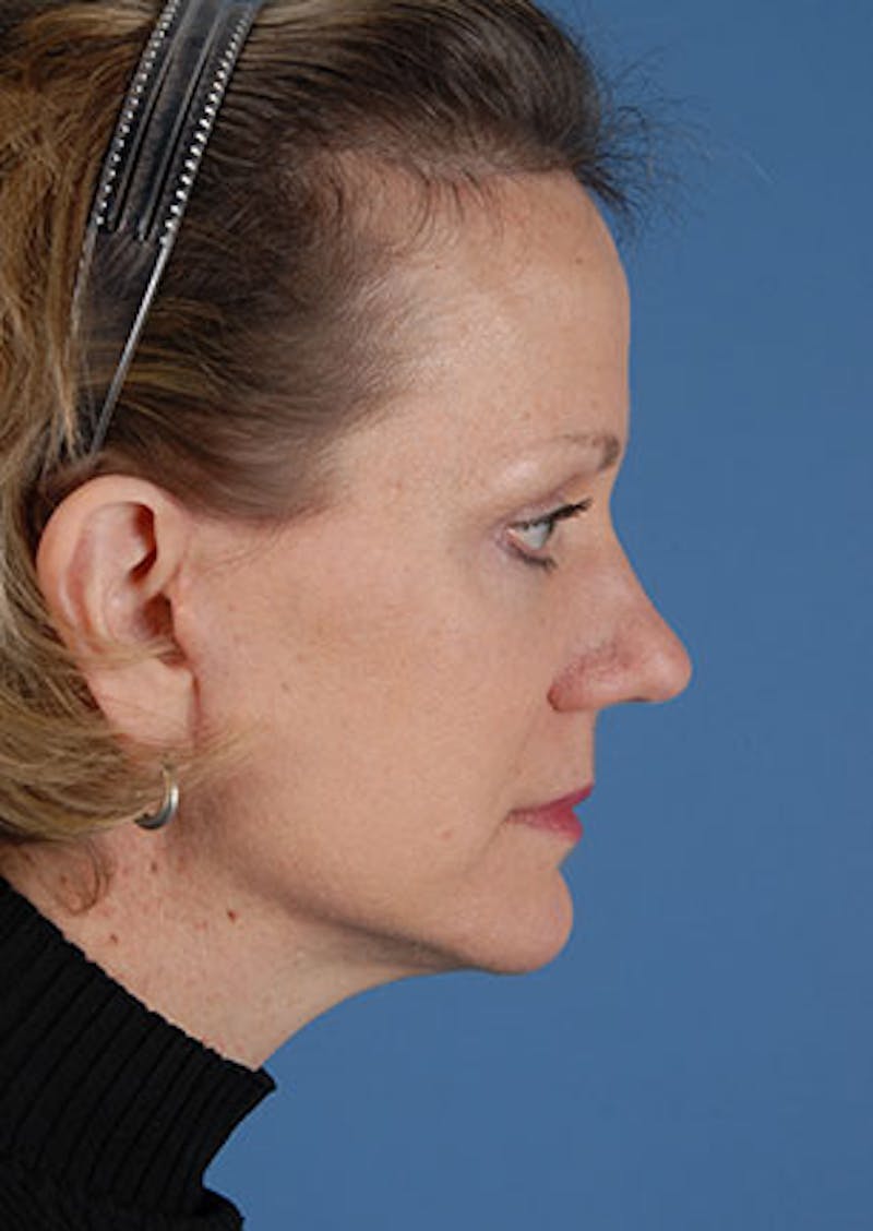 Facelift/Necklift Before & After Gallery - Patient 106537112 - Image 8