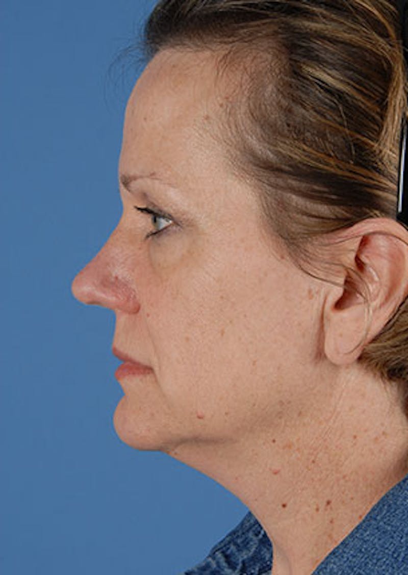 Facelift/Necklift Before & After Gallery - Patient 106537112 - Image 9