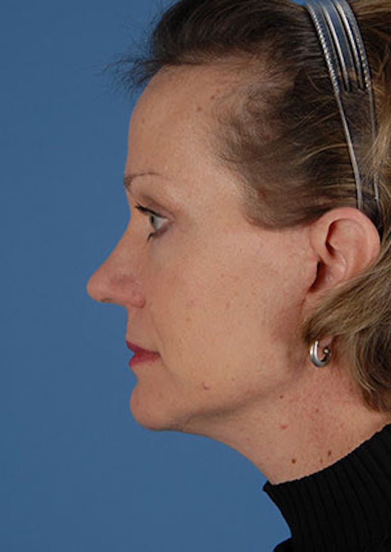 Facelift/Necklift Before & After Gallery - Patient 106537112 - Image 10