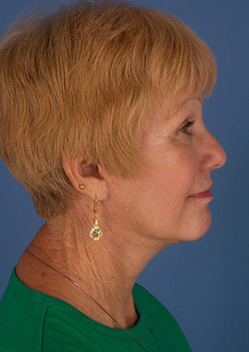 Facelift/Necklift Before & After Gallery - Patient 106537133 - Image 8