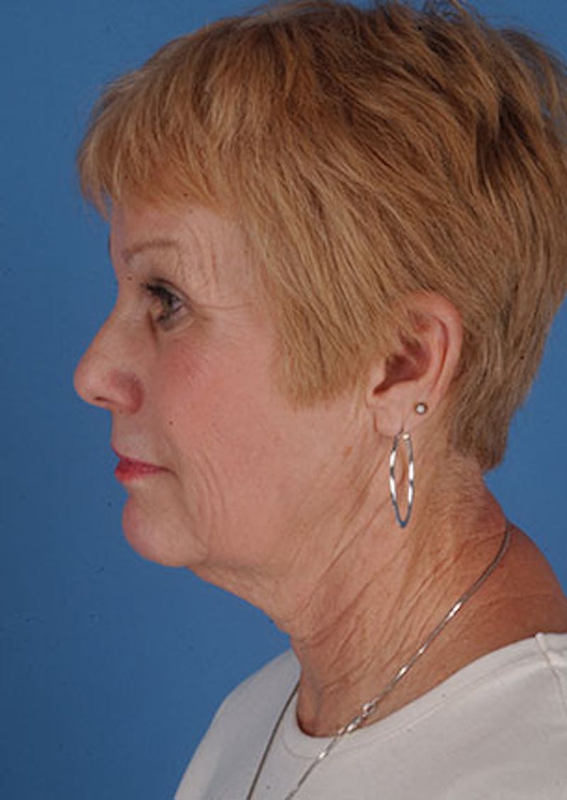 Facelift/Necklift Before & After Gallery - Patient 106537133 - Image 9