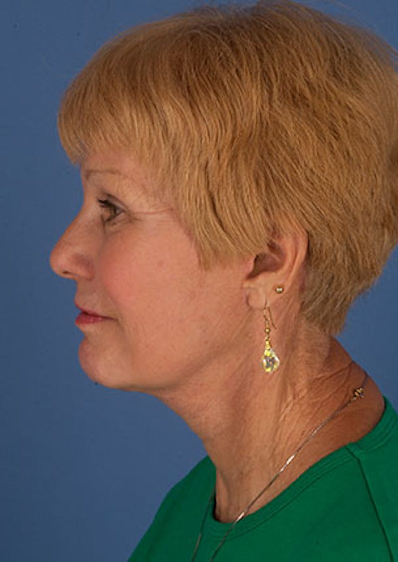 Facelift/Necklift Before & After Gallery - Patient 106537133 - Image 10