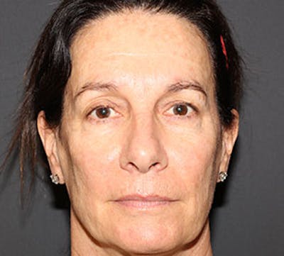 Browlift/Upper Blepharoplasty Before & After Gallery - Patient 106566624 - Image 1